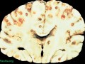 Pork tapeworms on the brain