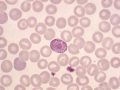 What Does a Low White Blood Cell Count Mean?