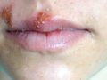 Does Tea Tree Oil Work on Warts and Cold Sores?