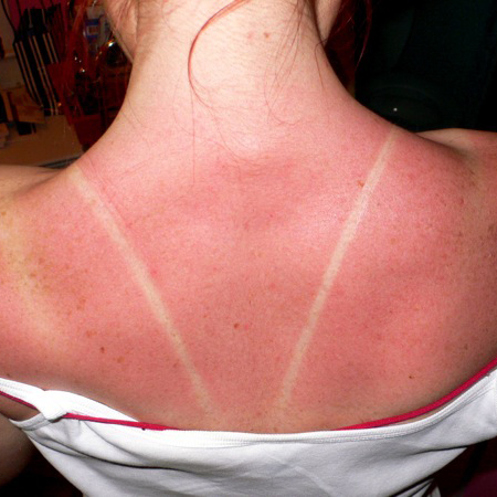 Sunburn